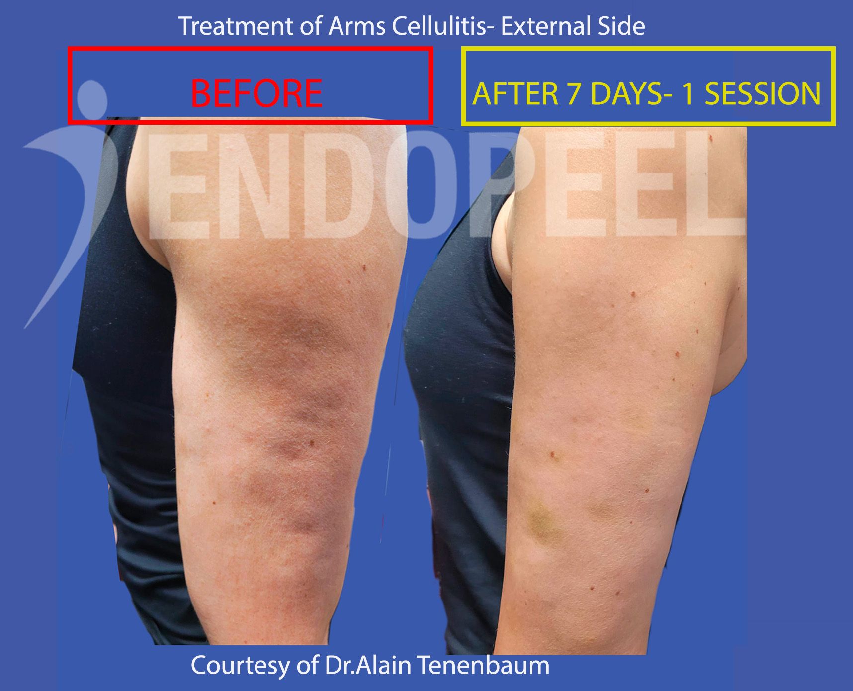 arms-cellulitis-final