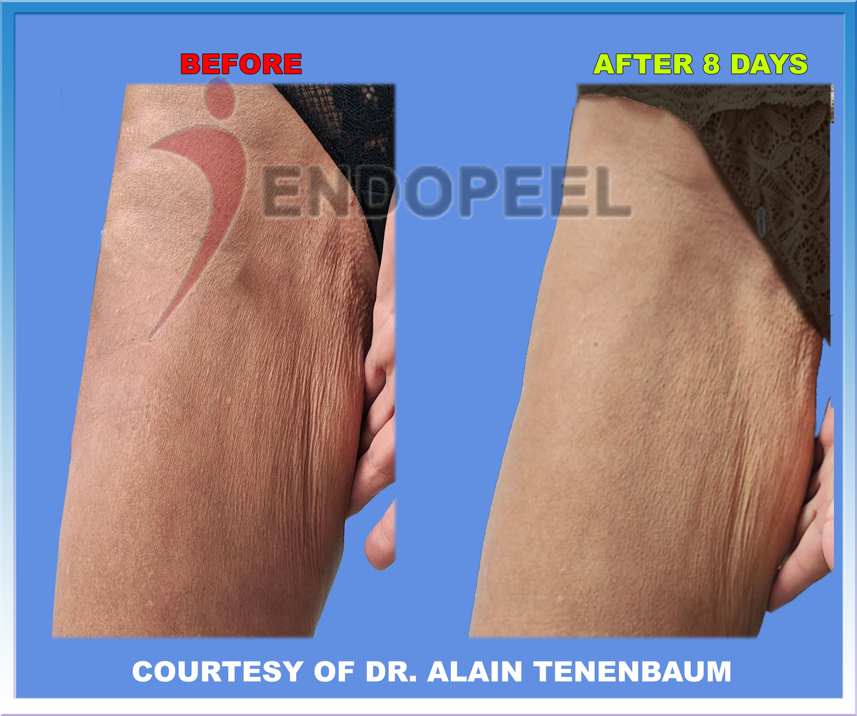 endopeel-thigh-plasty