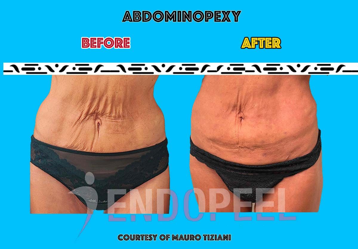 Abdominoplastik