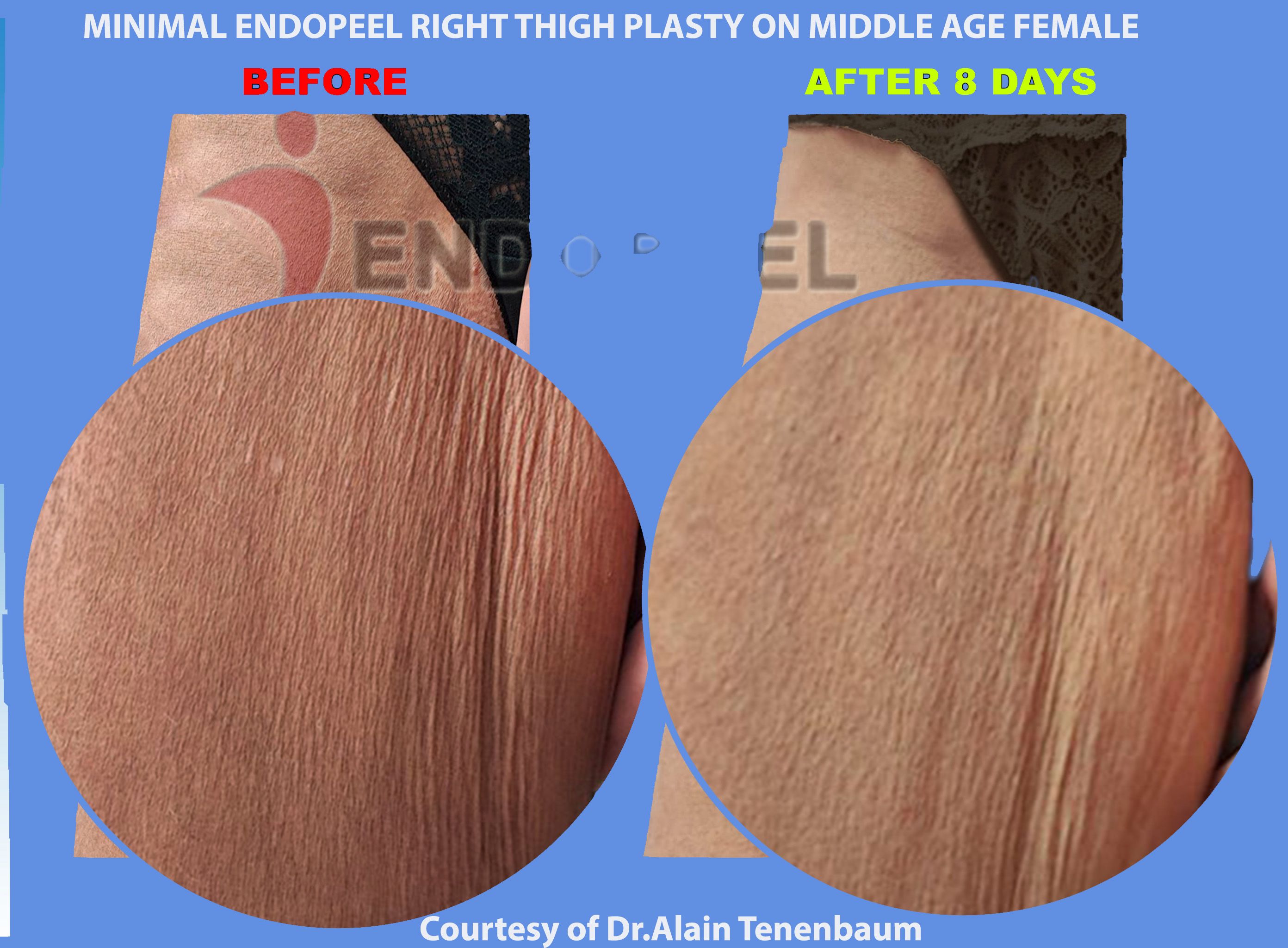 endopeel-thigh-plasty-zoom