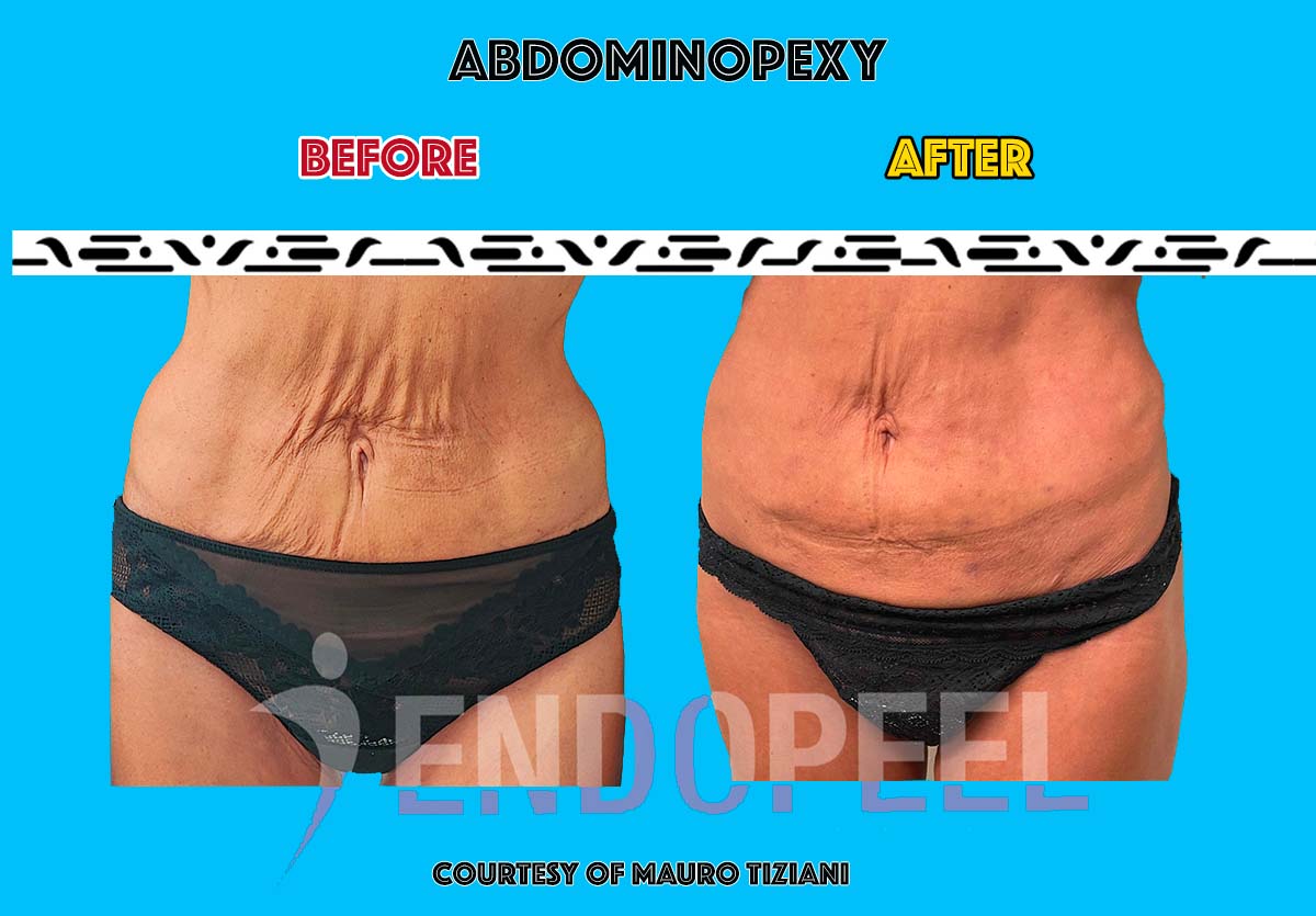 Abdominoplastik