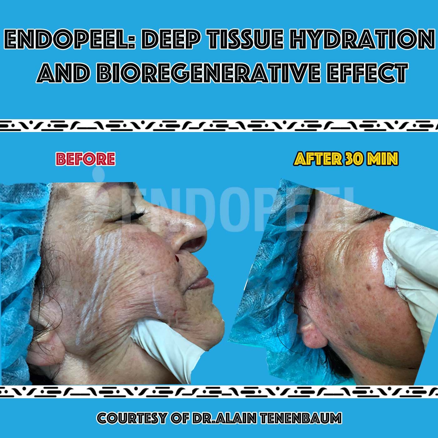 Hydratation-bioregenerativ-Endopeel