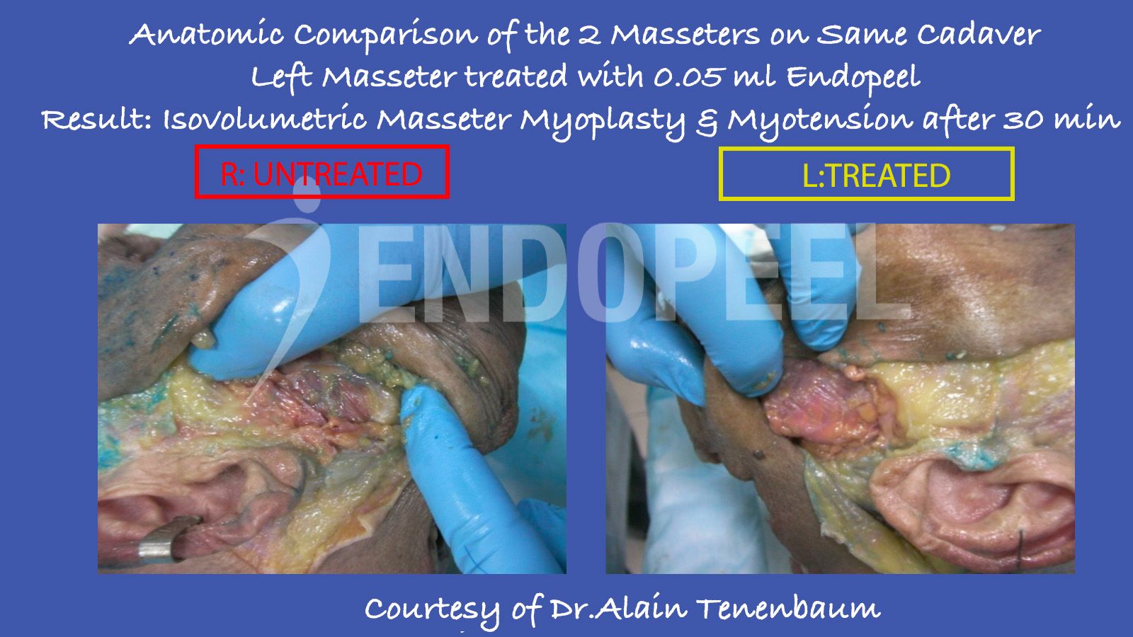 comparison of masseters on same cadaver with one side treated with endopeel