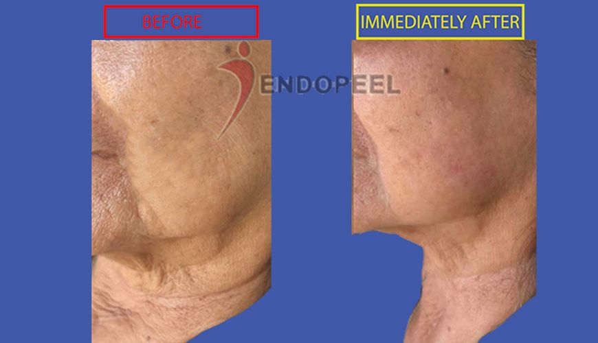 endopeel for aging face